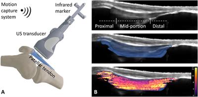 Patellar Tendon Shear Wave Velocity Is Higher and has Different Regional Patterns in Elite Competitive Alpine Skiers than in Healthy Controls